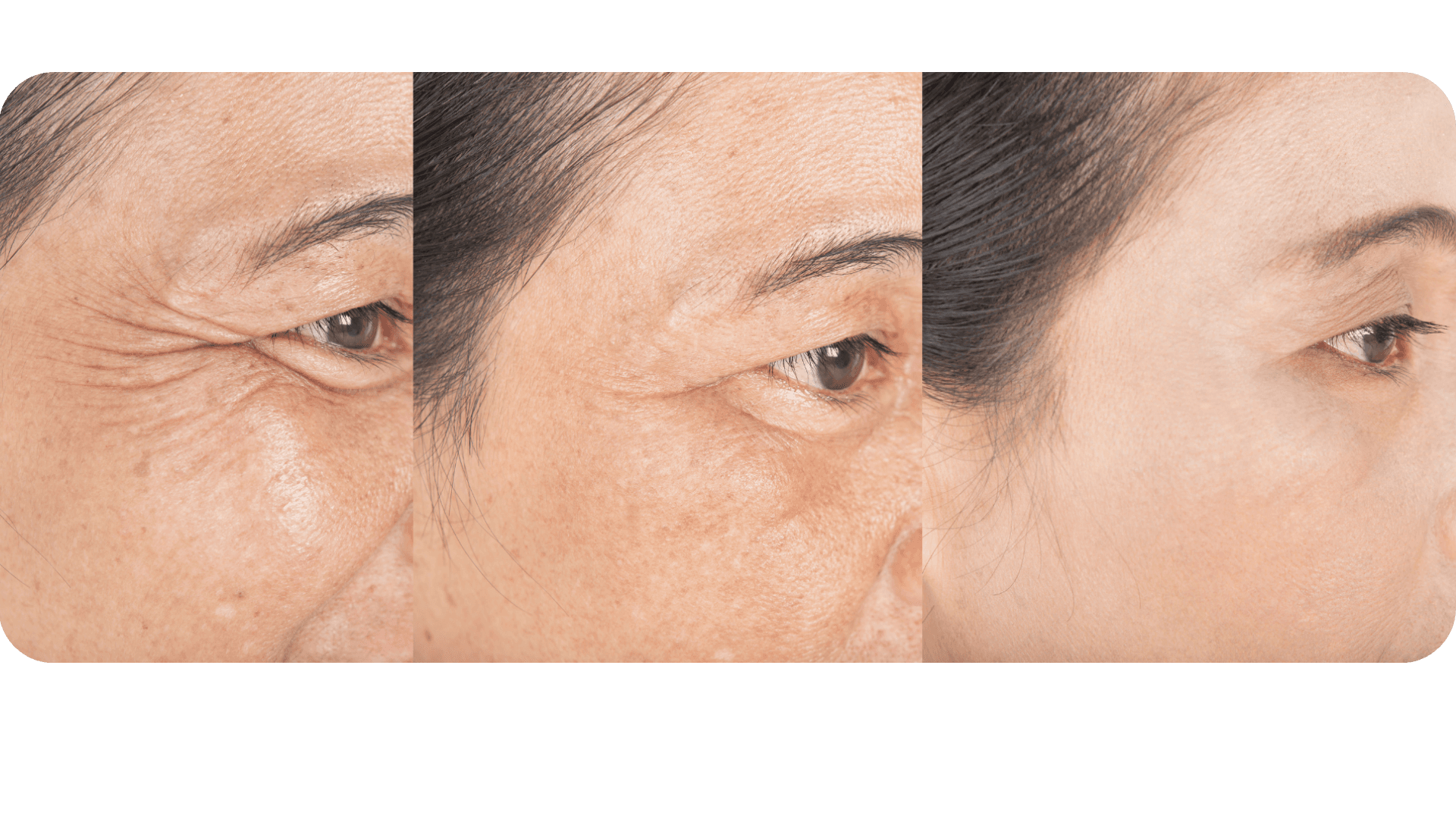 Diferencias entre Bótox y Ácido Hialurónico: ¿Cuál es la mejor opción para ti?