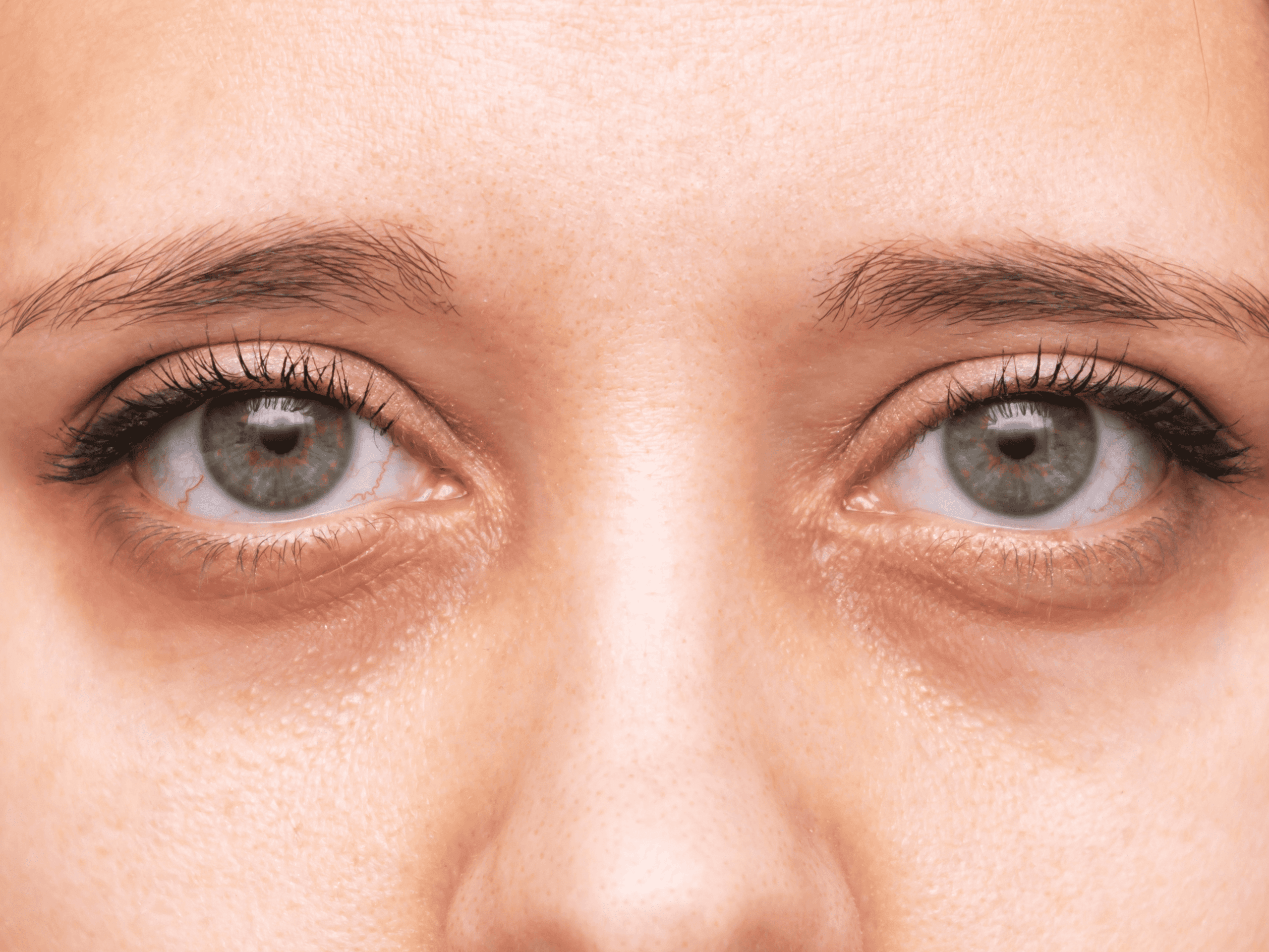 Bulto después de ojeras con ácido hialurónico: por qué aparece y cómo se soluciona